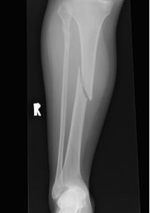 Tibial Midshaft Fracture